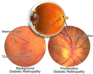 img-diabetic-retinopathy